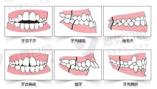 钴铬合金支架树脂牙（牙支架的种类及价格）(图1)